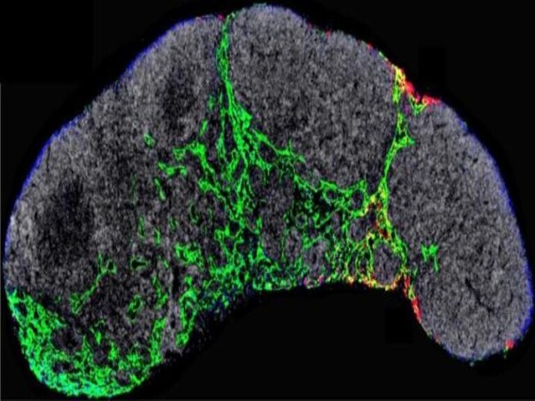 Descubren mecanismo que causa la metástasis del melanoma y cómo frenarlo