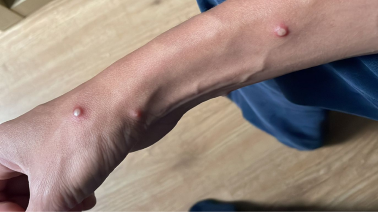 Yucatán con 24 casos de viruela símica; detectan 6 nuevos casos