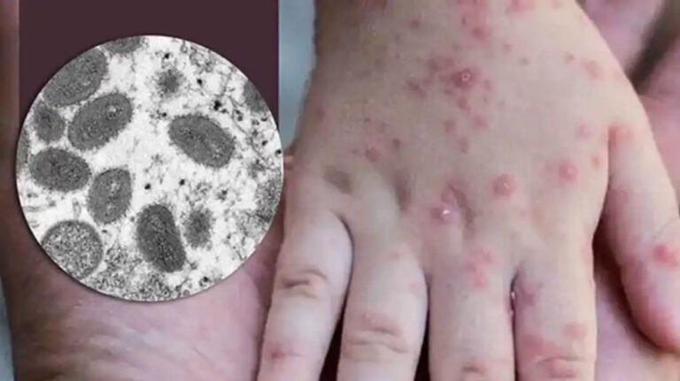 En aumento los casos de Viruela del mono en México